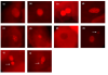 Images of different types of nuclear changes detected in buccal cells